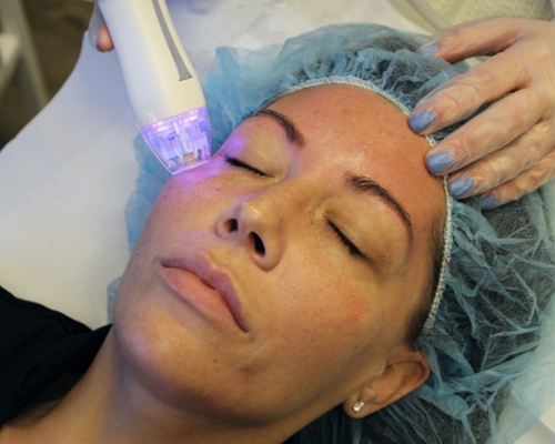 Inicio Microneedling H
